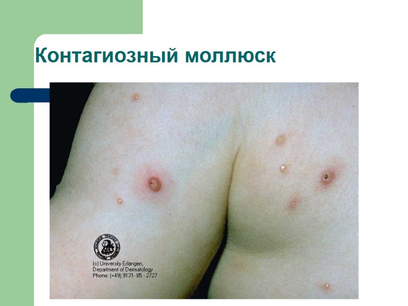 Контагиозный моллюск